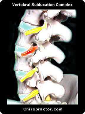 Subluxation